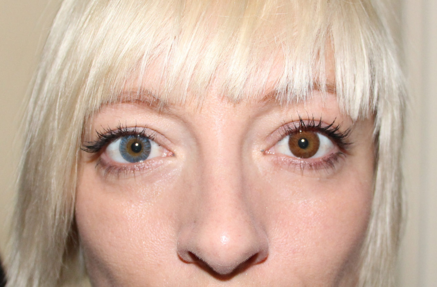Heteros Chroma, One Blue Eye + One Brown Eye
